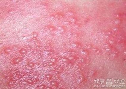 生殖器疱疹的话,可有丘疹和水泡,患者朋友们可能感受到瘙痒和灼烧样的