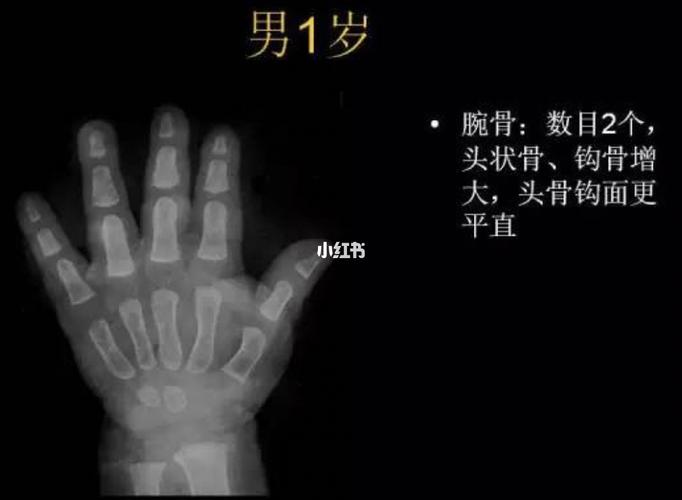 一岁到五岁骨龄鉴别图_医学生_医疗健康_医疗健康其他