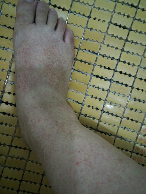 2016-06-22 23:01    浏览  33333  为您推荐: 其他回答 过敏了