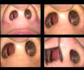 鼻中隔偏曲病因