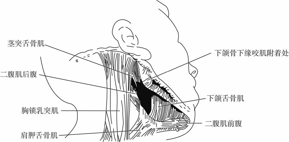 下颌下间隙感染