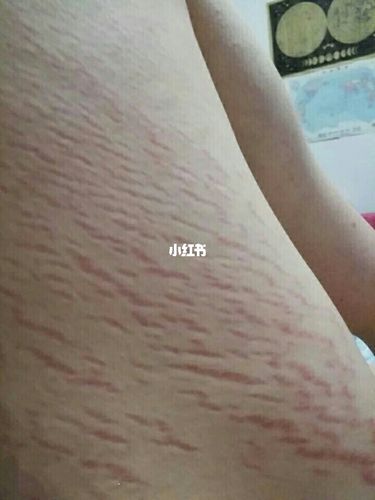 我才18岁啊,腿上长肥胖纹也是要命了!