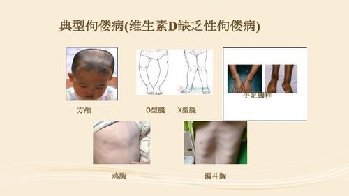 维生素d与婴幼儿佝偻病