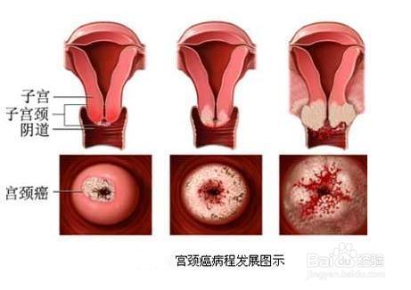 怎么及时发现癌症的早期症状,防患于未然