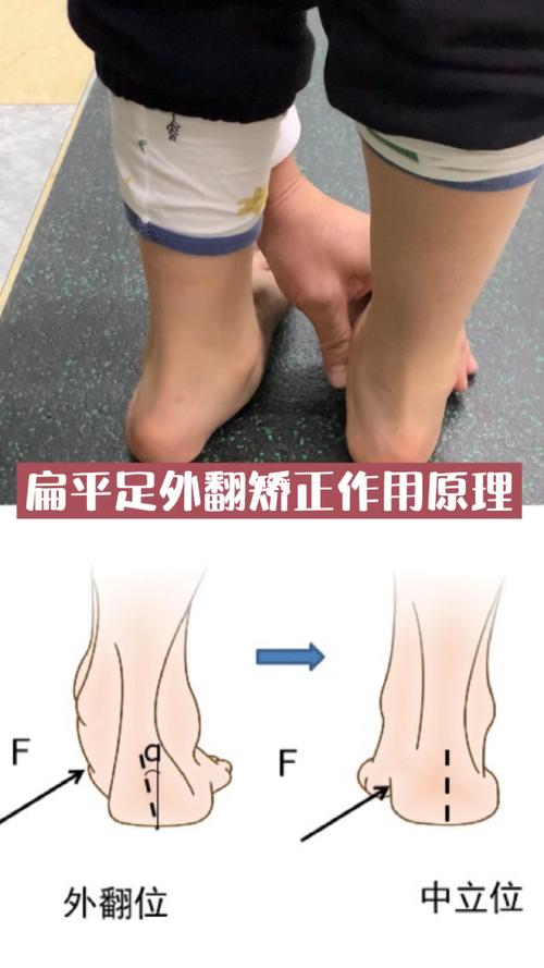 儿童扁平足和足外翻的矫正原理是什么?_水立方怎么样