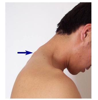 脊椎矫正之脊柱的棘突与椎体的定位