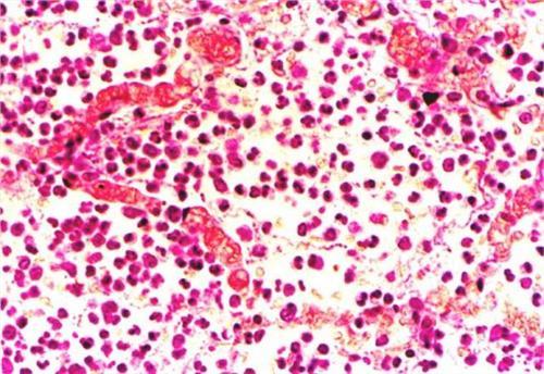 小叶性肺炎的合并症有 a.肺肉质变b.肺脓肿c.脓毒败血症d.