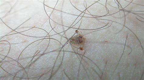 眼科疾病 眼病综合 眼科诊室 > 正文 阴虱的主要传播方式有三种,分别