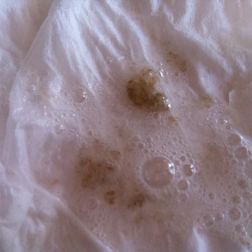 两周前拍ct得出局限性支扩(湿扩吧)我之前咳唆咳痰(得过肺结核见局限