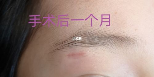 脸部皮脂腺囊肿术后恢复情况_疤痕_祛疤膏_创口贴_防晒_帽子_医疗健康