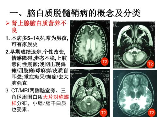 脑白质脱髓鞘疾病.pdf 36页