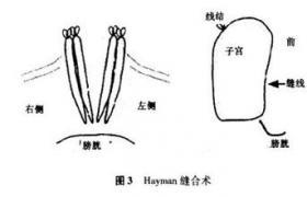 妊娠期子宫内口缝合术