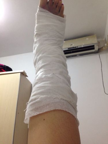 怎么办我骨折然后脚很痒我就把绷带解开了