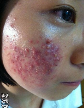 面部痤疮合并马拉色菌感染
