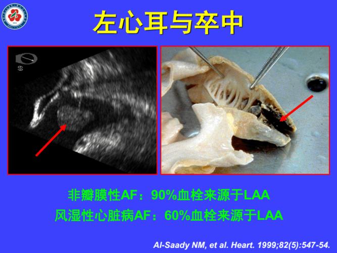 医学交流课件:心房颤动患者-左心耳如何处理.pdf 50页