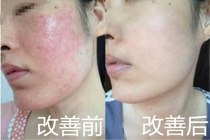 【蝶渡敏感肌修复案例连载006】激素脸冬天为什么会