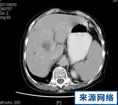 肝囊肿ct图(2)(2/5)