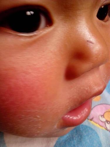 宝宝脸干起皮怎么办