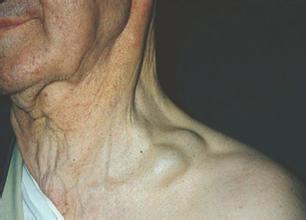 胸锁骨关节炎症状