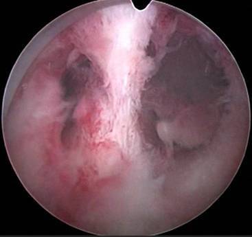 图1.5 宫腔镜下见子宫宫腔粘连