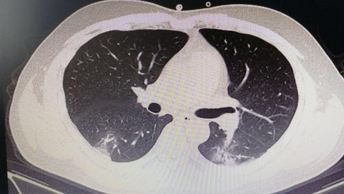 其它 阅图识病之新冠肺炎一例 写美篇 影像所示: 双肺可见多发大小不