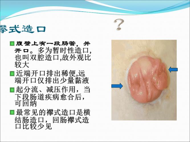 结肠造口病人的清洁灌肠方法