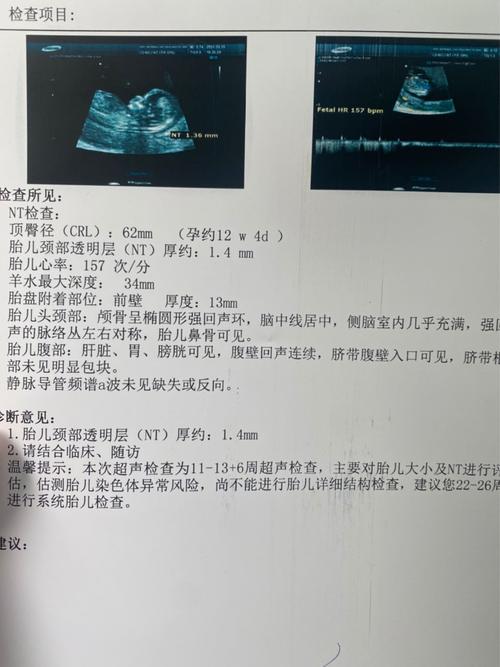 [试管婴儿]nt一次过,能看出来男孩女孩吗