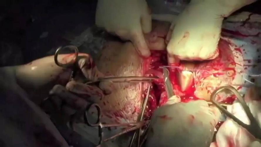 内部处理完之后,就要开始进行伤口缝合了.