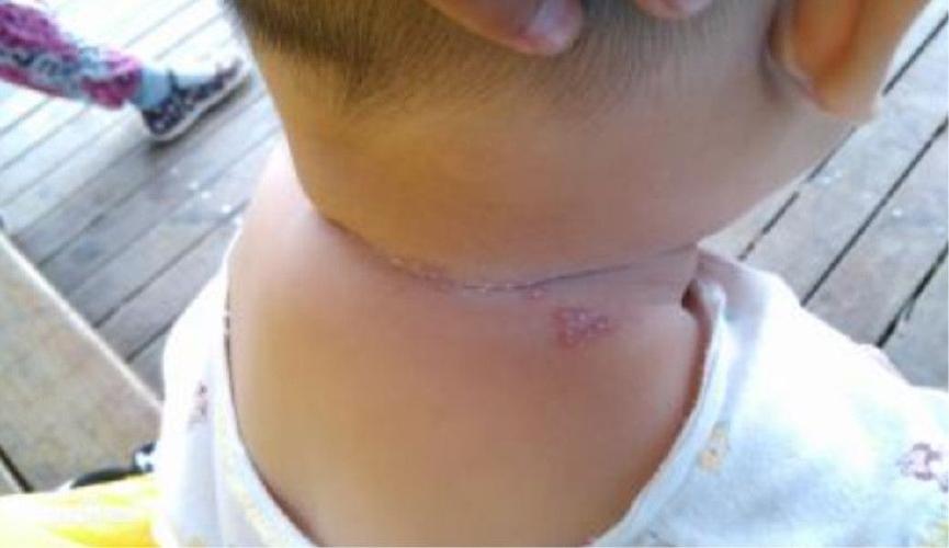 满月孩子"淹脖子",看着就心疼,宝妈这样做避免二次伤害