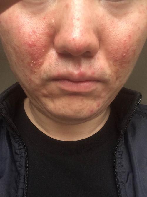 激素皮炎在吃到某些"发物"后,皮炎症状会加剧反跳.这些"发物"是什么?