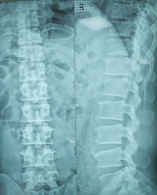 正侧位x线示:生理曲度消失,胸腰段微后凸