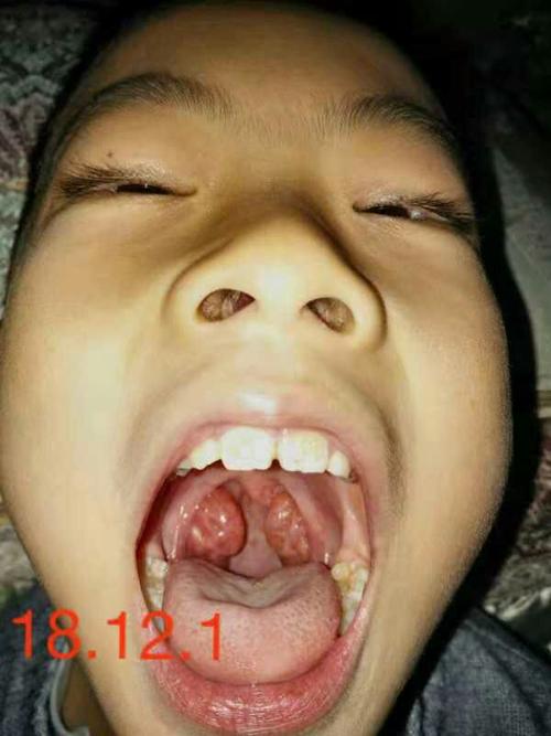 伙伴扁桃体肿大调理,父母们,别动不动就给孩子切除扁桃体,那可是人体