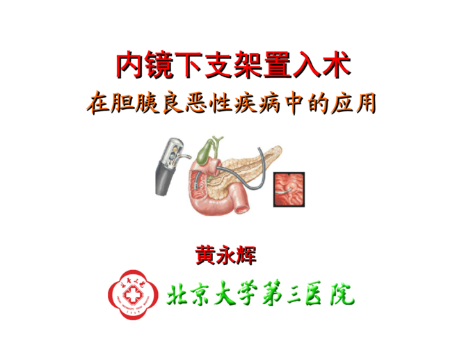 内镜下支架置入术在胆胰良恶性疾病中应用黄永辉.ppt