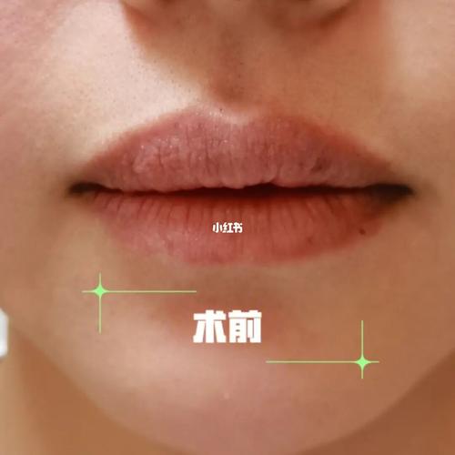m唇前后对比_玻尿酸_丰唇_m唇_美妆_医美整形