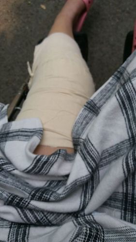 左膝盖韧带撕裂,小腿骨折,当时打了石膏,等手术 做完手术半个月吧