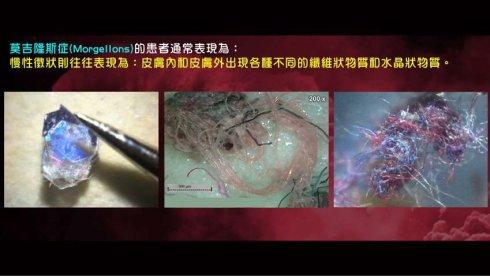 将人体变成工厂-莫吉隆斯症