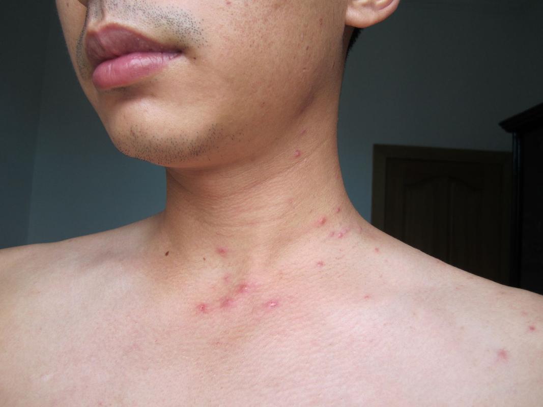 请专业医生诊断这是不是艾滋病窗口期皮疹