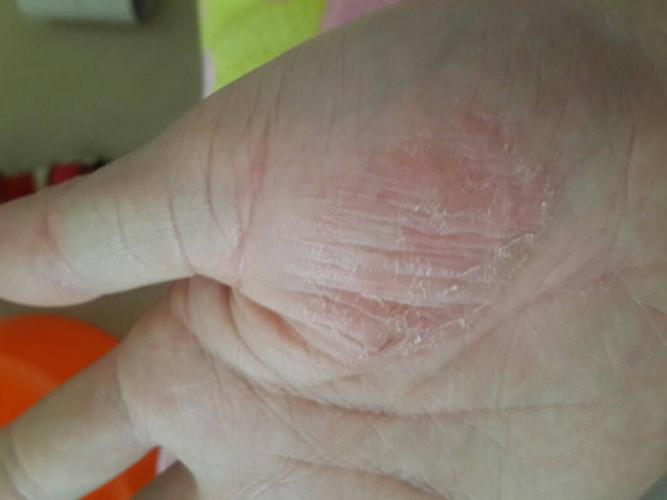 我的手掌这块是什么?有时候会痒,抓了之后就脱皮,不去