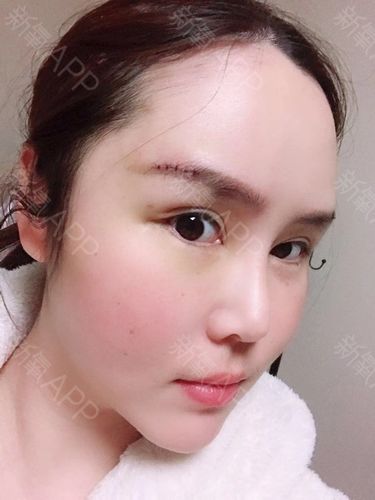 武汉假体垫眉弓好不好_效果图_z46a1假体垫眉弓术后第4天_新氧美容
