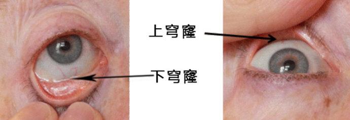 单眼患者,你的义眼片还戴得上吗?丨上下穹窿重建