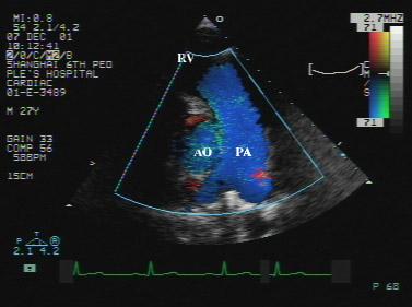 正常超声心动图-超声诊断学