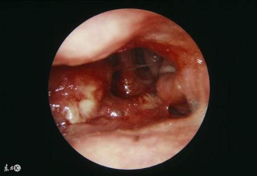 有这五大症状,早期鼻咽癌在向你招手!越早发现治疗率更高