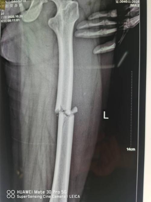 其它 刘威的美篇 写美篇贺**,女,左股骨干中段骨折,行股骨干骨折闭合