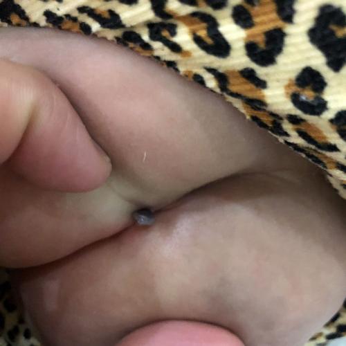 宝宝出生的时候,屁股沟里就长个小肉疙瘩,到今天整整四个月,今天擦