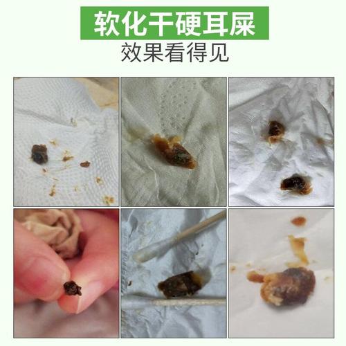 碳酸氢钠滴耳液剂人用软化耳屎硬耳垢去耵聍水洗油儿童宝宝铁耳屎