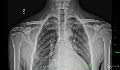 求助,各位老师看看是否肩锁关节脱位?