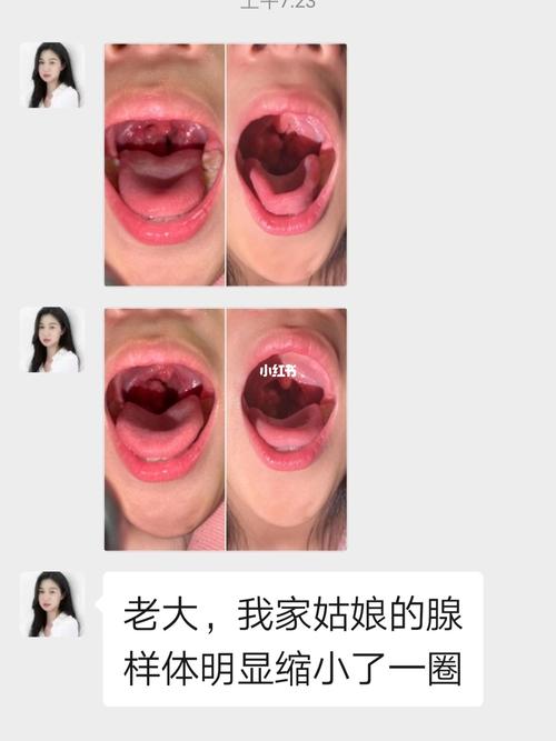 儿童腺样体肥大的精油反馈_精油_母婴_育儿经验