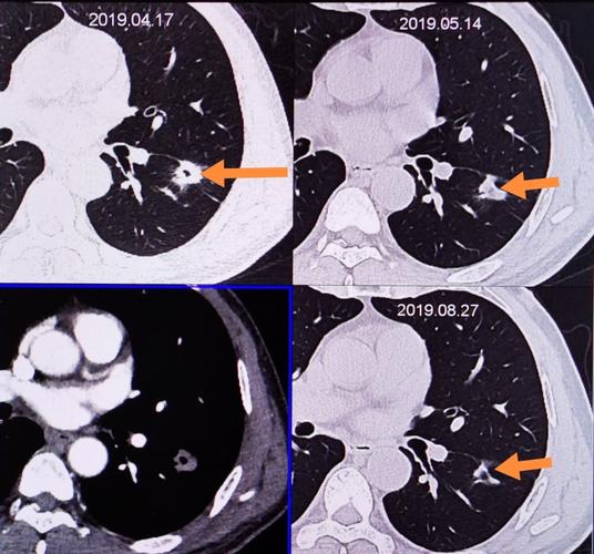 ct查出肺结节为什么不切?等它长大吗?