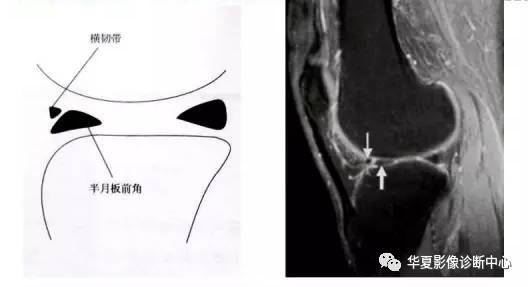外侧半月板前角中央部