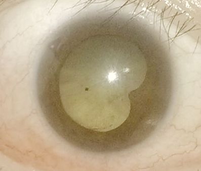 刘曙光教授,我是虹膜炎患者瞳孔部分粘连.